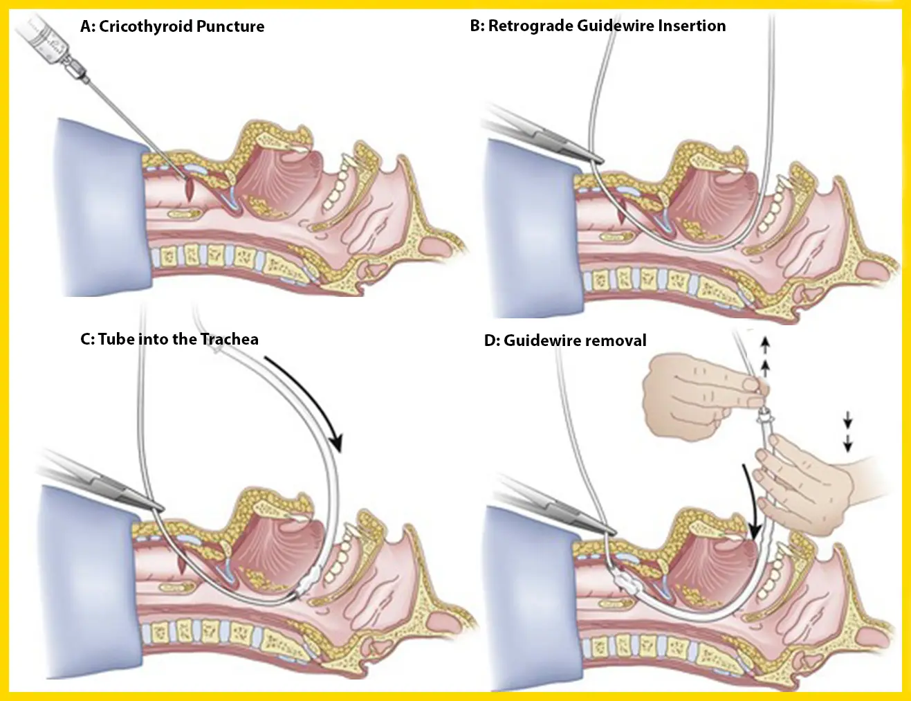 Illustration der retrograden Intubation in vier Schritten.