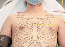 Anatomical overlay highlighting the 2nd intercostal space at the mid-clavicular line for needle decompression.