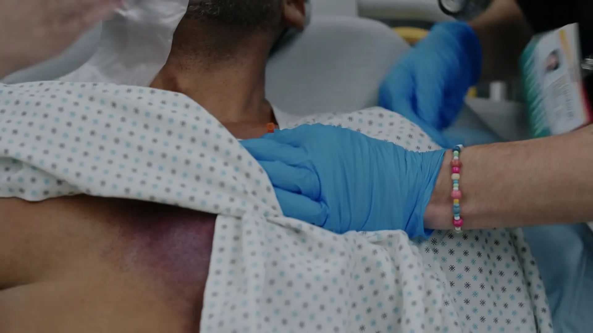 The treating physician performing a needle decompression with a 14-gauge angiocath, noting the audible hiss of escaping air as the pleural space is breached.
