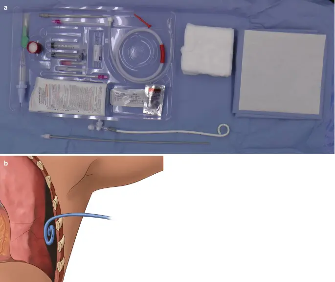 Pigtail catheter kit components and anatomical illustration of placement.